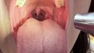 Gardło oświetlane otoskopem