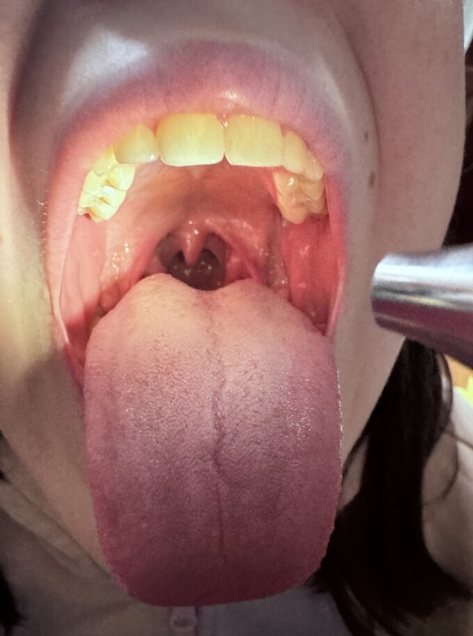 Gardło oświetlane otoskopem