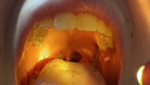 Gardło oświetlane Mactronic MedLite