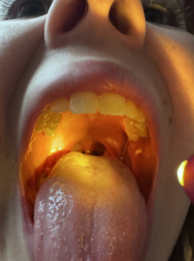 Gardło oświetlane Mactronic MedLite